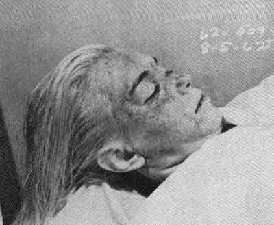 Marilyn Monroe autopsy photo (#1)