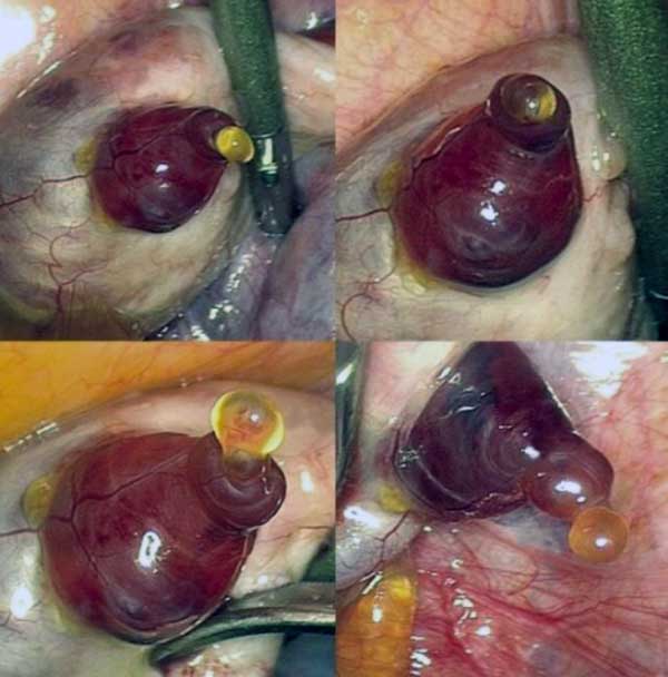 Egg emerging from an ovary