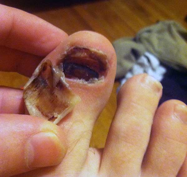 Flip-down toenail