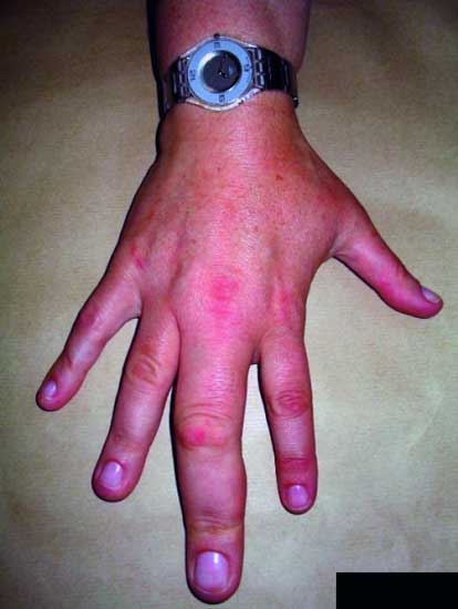Swollen finger