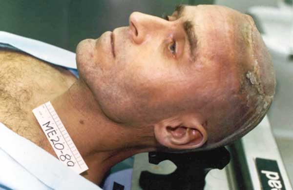 Ted Bundy autopsy photo