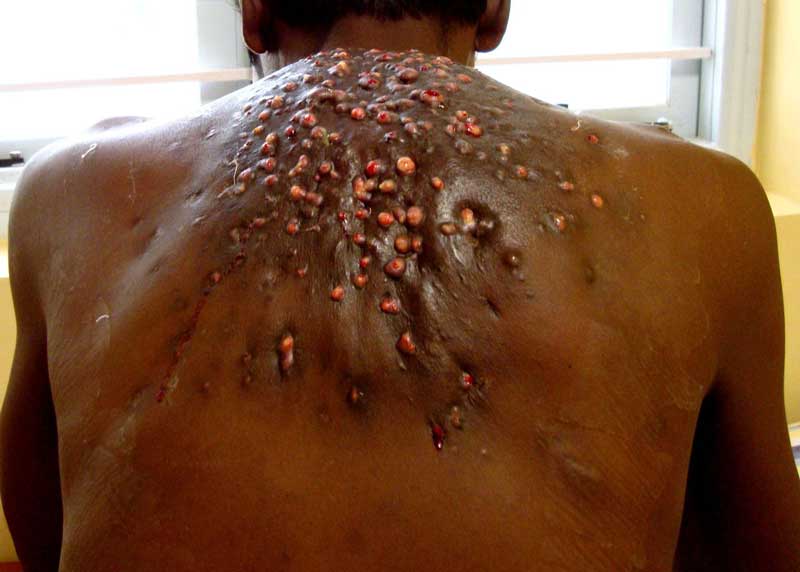 Botfly infection in a man's back
