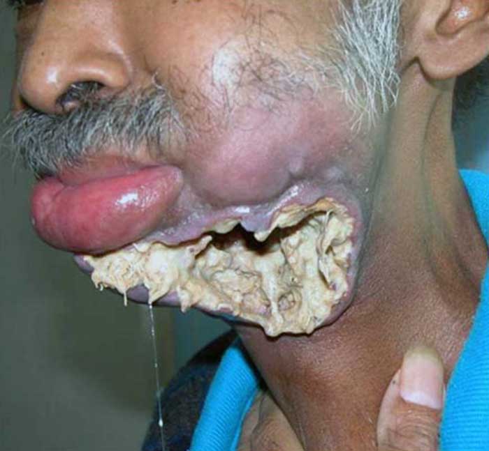 Cancer caused by chewing tobacco