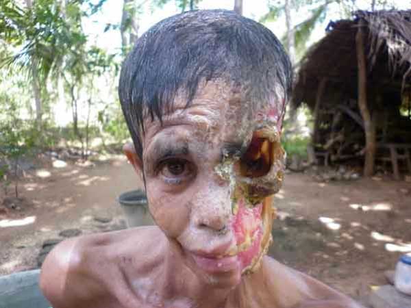 Flesh-eating disease of the face