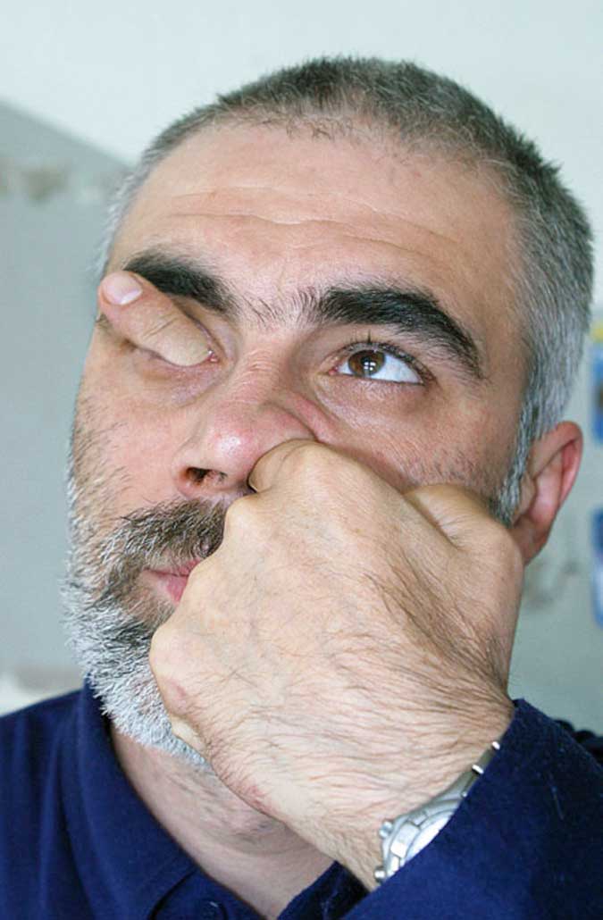 Man sticks a finger in his nose through his eye socket