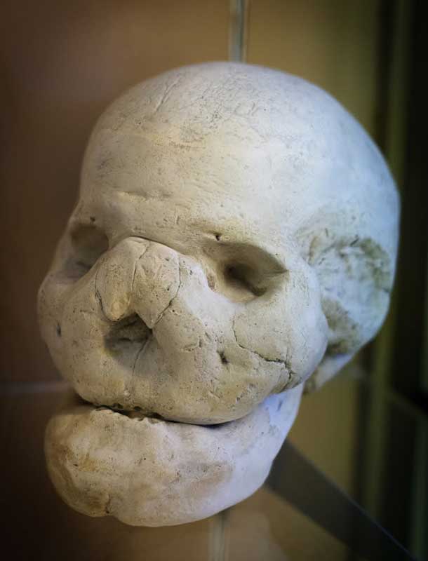 Leontiasis ossea, a.k.a. "lion face"