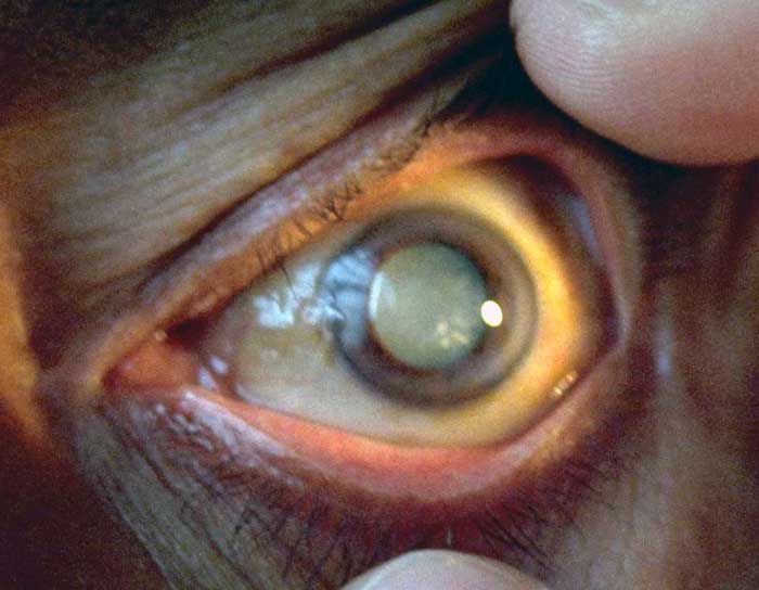 Cataract