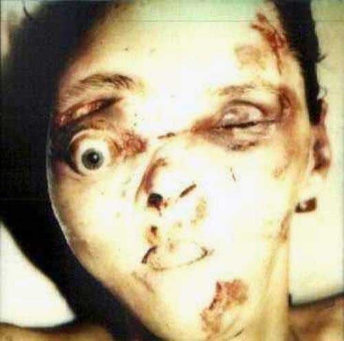 A rotting person with no eye