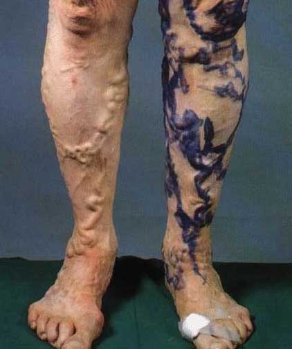 Severe case of vericose veins