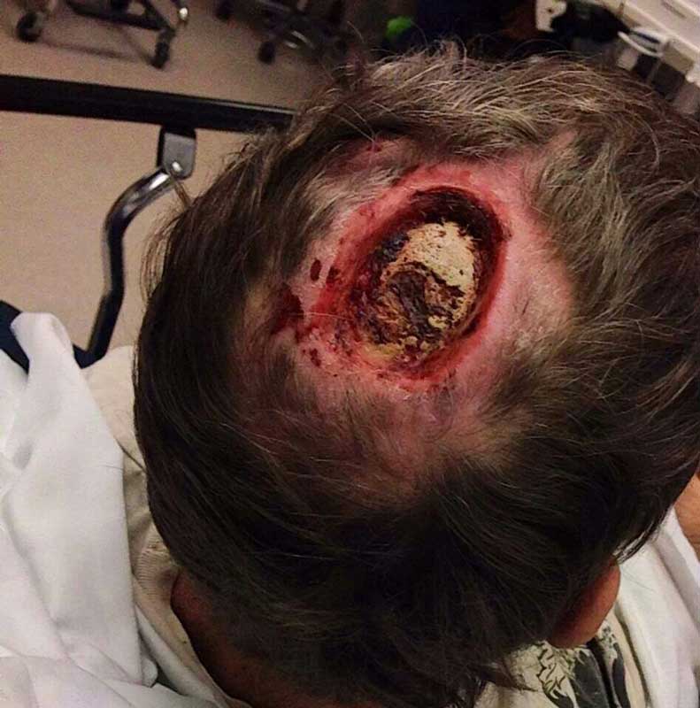 Meth addict picked his sore