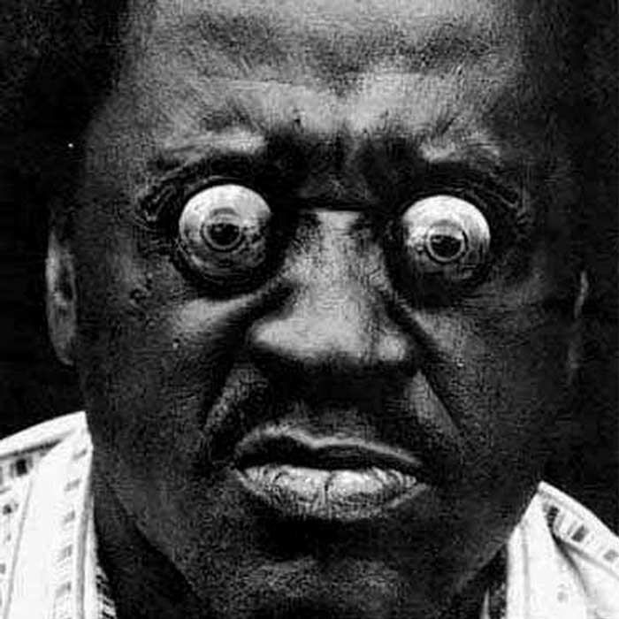 Extreme bulging eyeballs