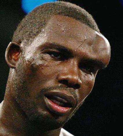 Boxer Hasim Rahman with a baseball-sized knot in his head
