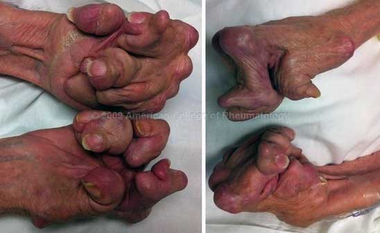 Untreated seropositive rheumatoid arthritis of the hands